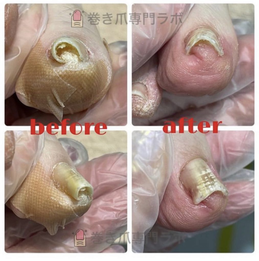 皮膚科で爪疾患の検査☝🏻