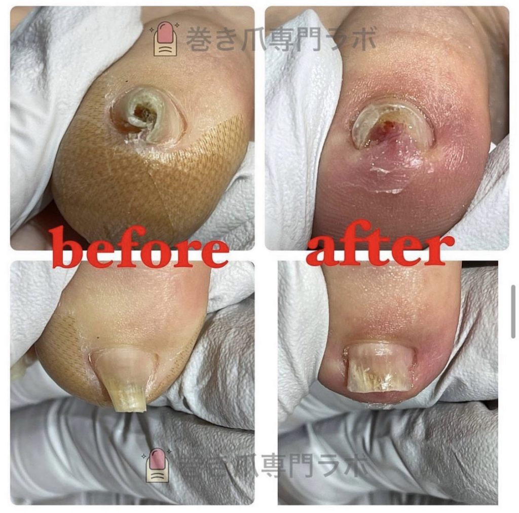 ぐるっと一周した2趾🌀