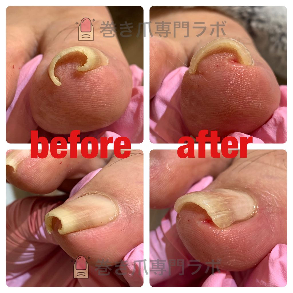 重度の巻き爪🌪️