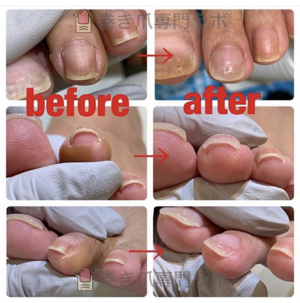 変色は爪の厚みかも🧐