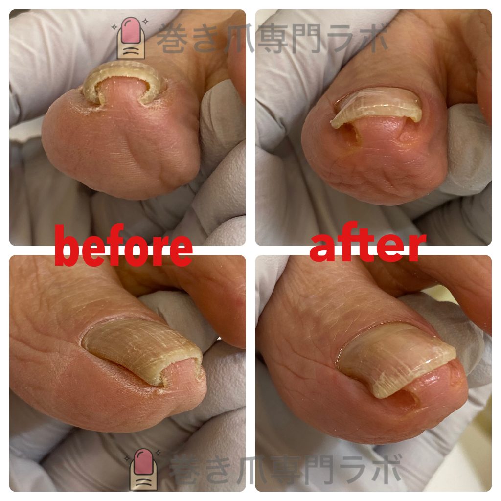 長年の巻き爪
