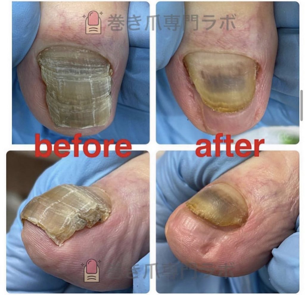 肥厚爪のアフターケアも✨