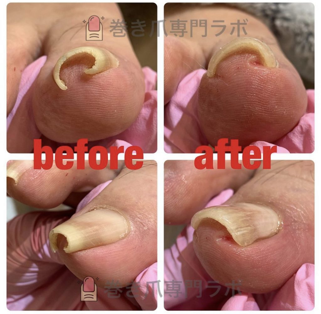 重度の巻き爪💦