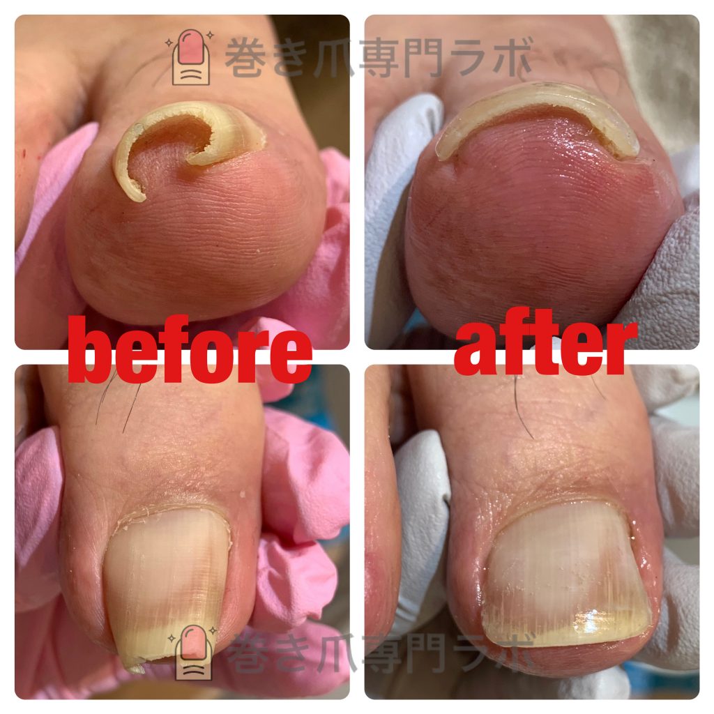 ご自身で出来る巻き爪ケア✨