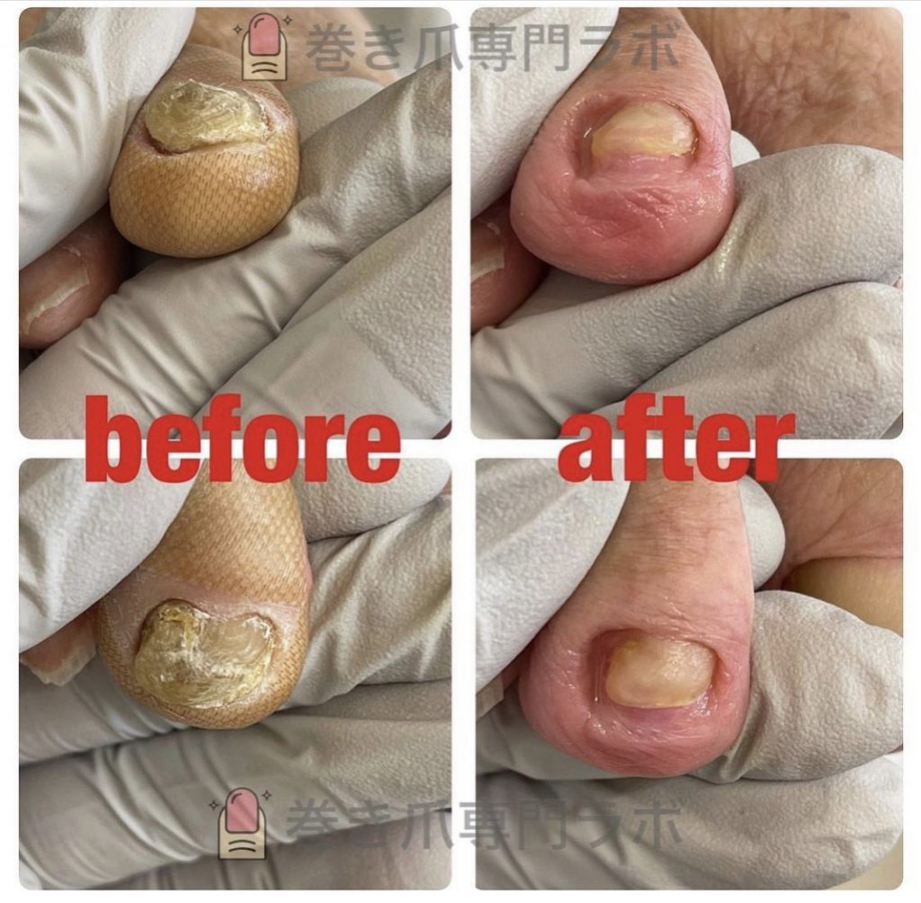 様々な原因で肥厚爪に💦