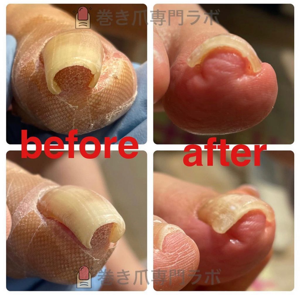 原因は外反母趾⁈🤔