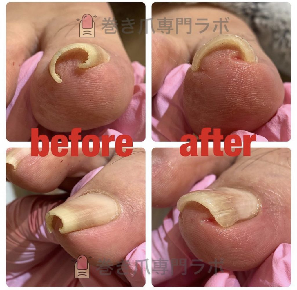 重度の巻き爪😱
