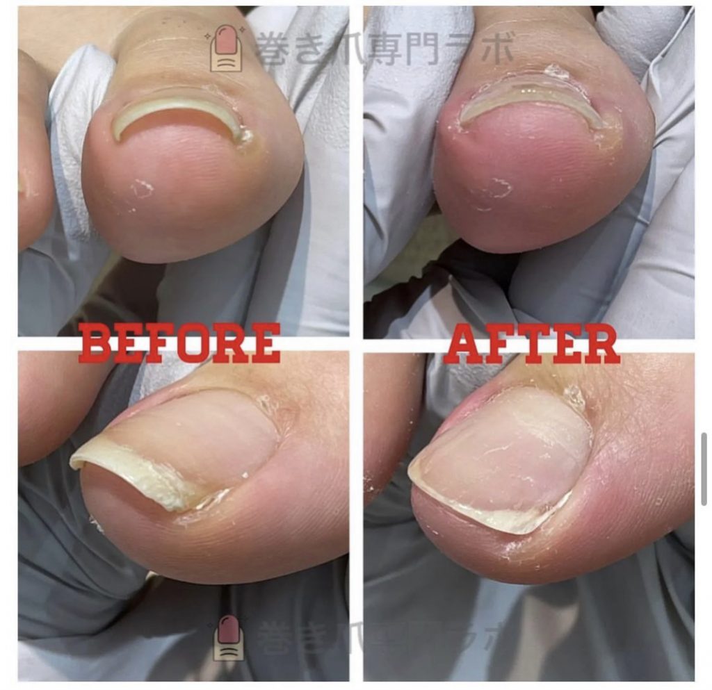 巻いてるように見えない爪でも