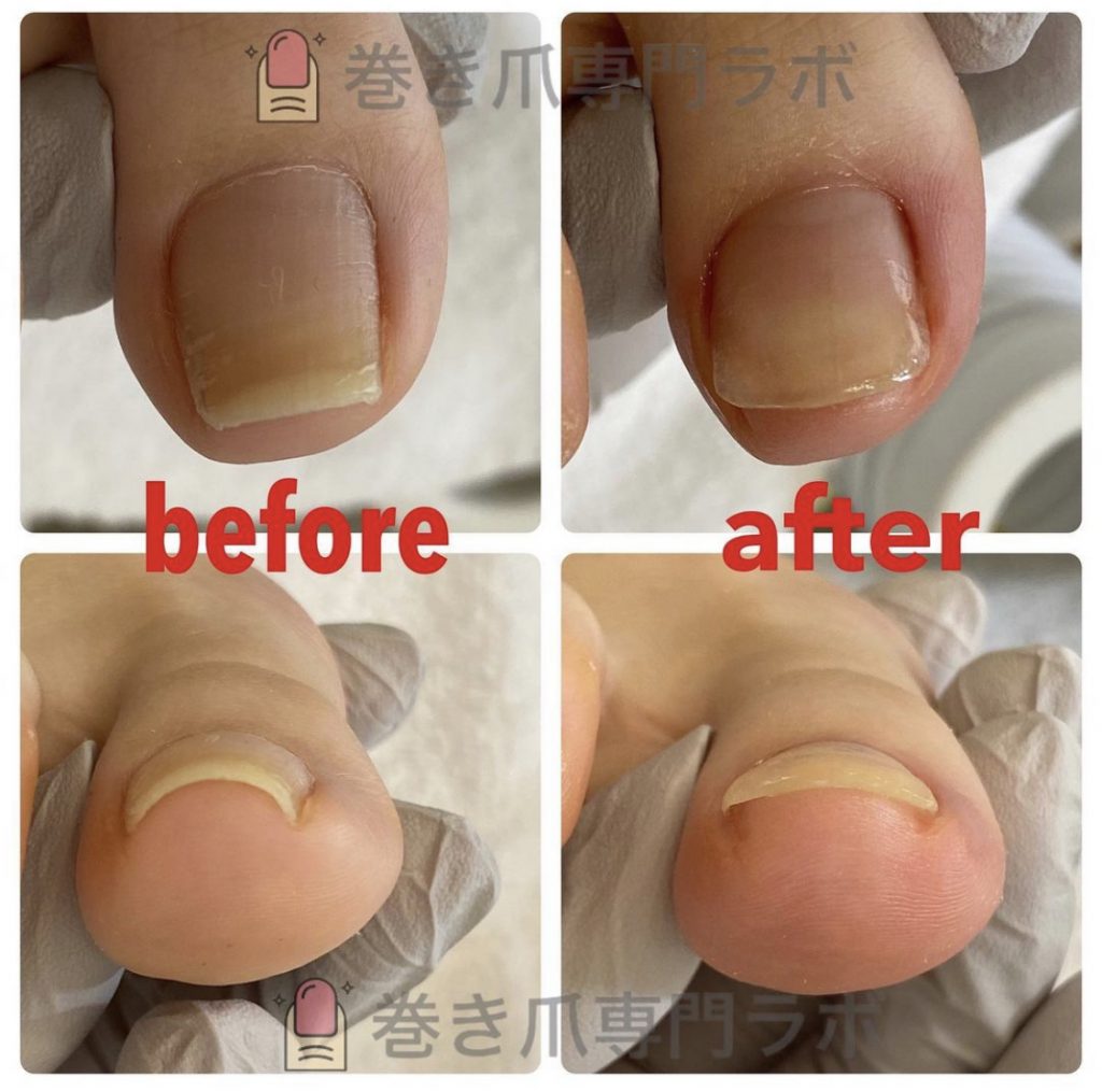 外反母趾も巻き爪の原因のひとつ