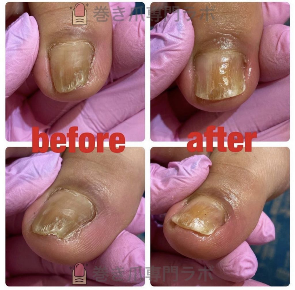 痛くなって、切っての繰り返し💦