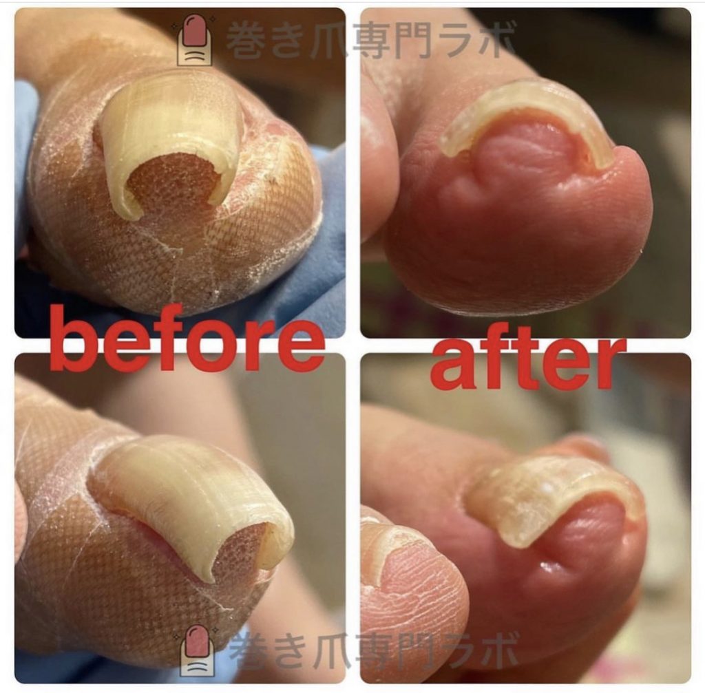 外反拇趾が原因で👣