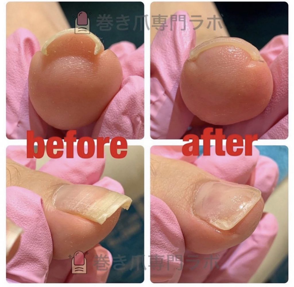 ホッチキスみたいなお爪