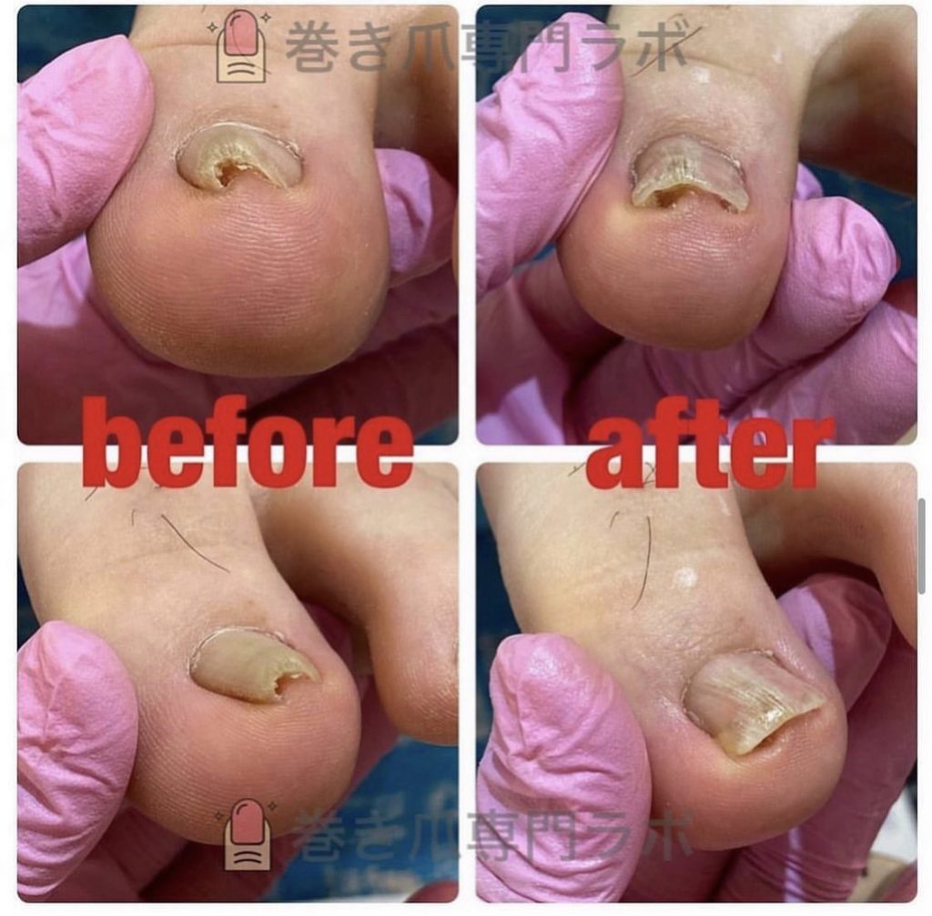 長年の巻き爪💦