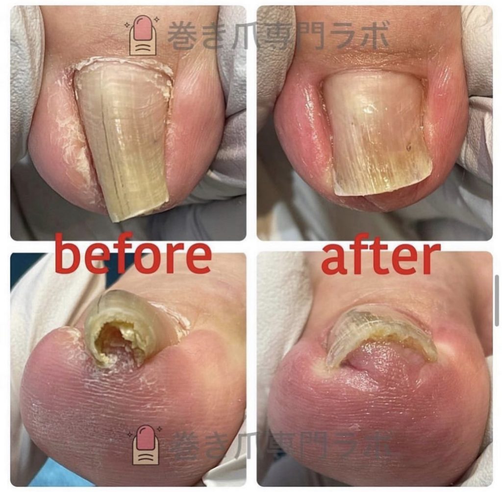 肥厚と巻き爪