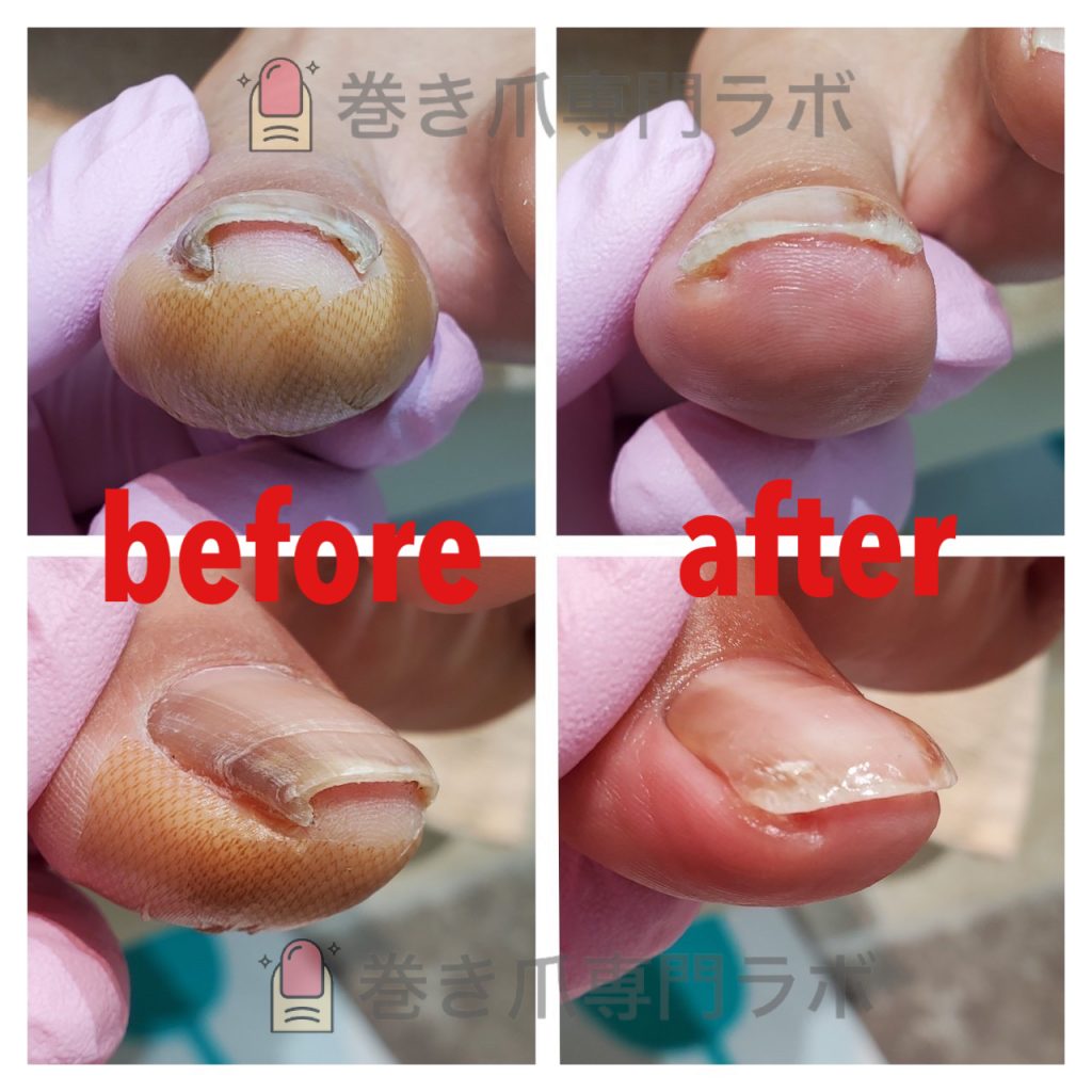 ホチキスのようなお爪