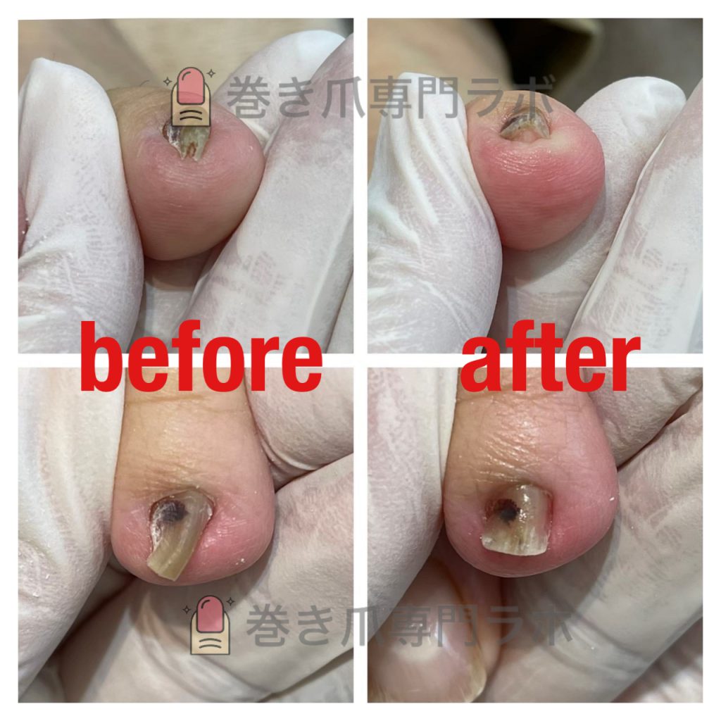 薬指の巻き爪