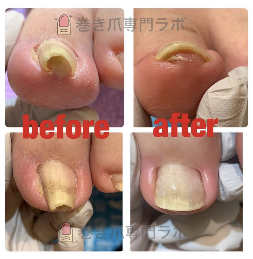 重度の巻き爪⚠️