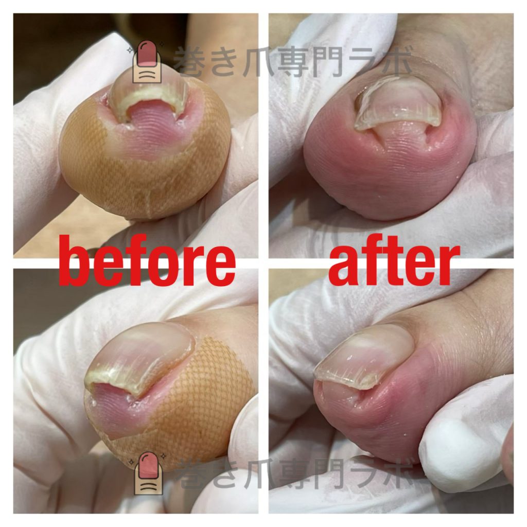 上に盛り上がった巻き爪さん