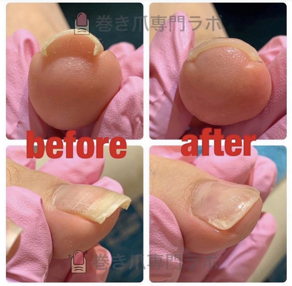 ホッチキスのように巻いた爪