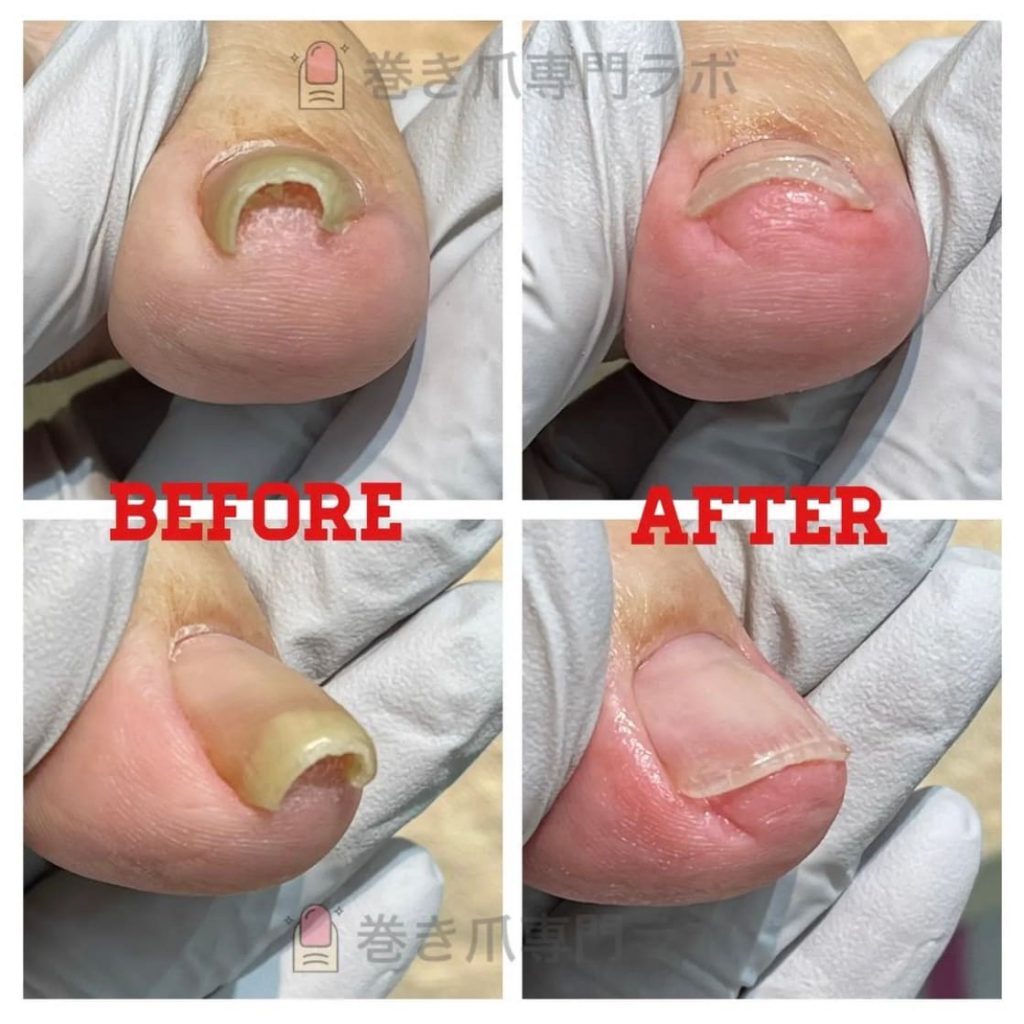 巻き爪に気付いてない方も…