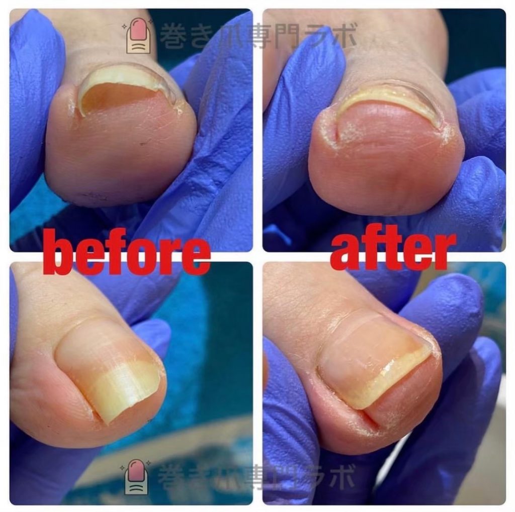 お爪本来の形に、、