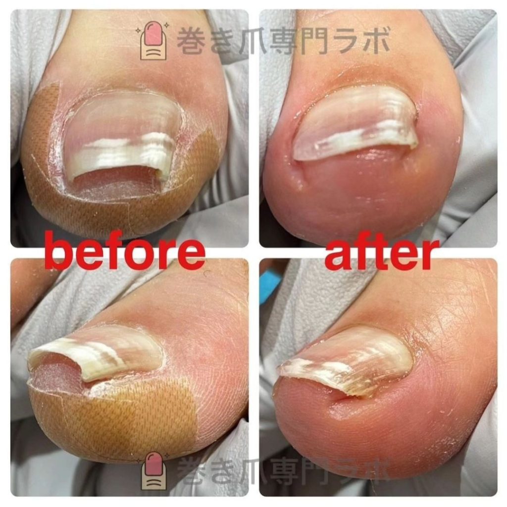 巻き爪の痛みも各々違います。