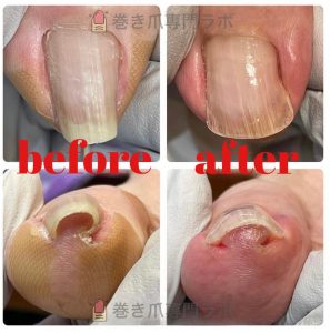 【巻き爪】「痛くてヒールが履けない…」幅広の靴しか選べなかったお悩みが1回の補正で解消！好きな靴を楽しめる足元へ｜巻き爪専門ラボ