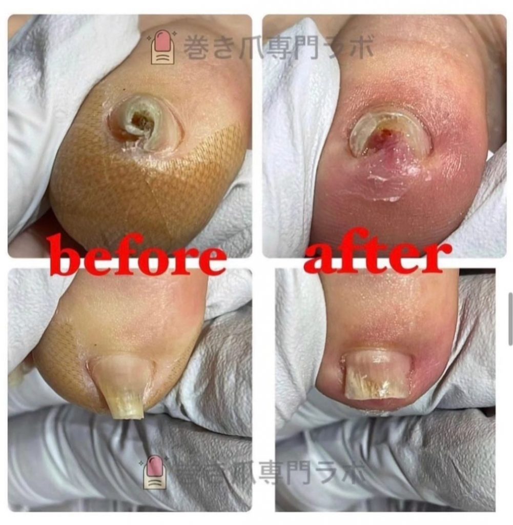 「の」の字になった爪でも