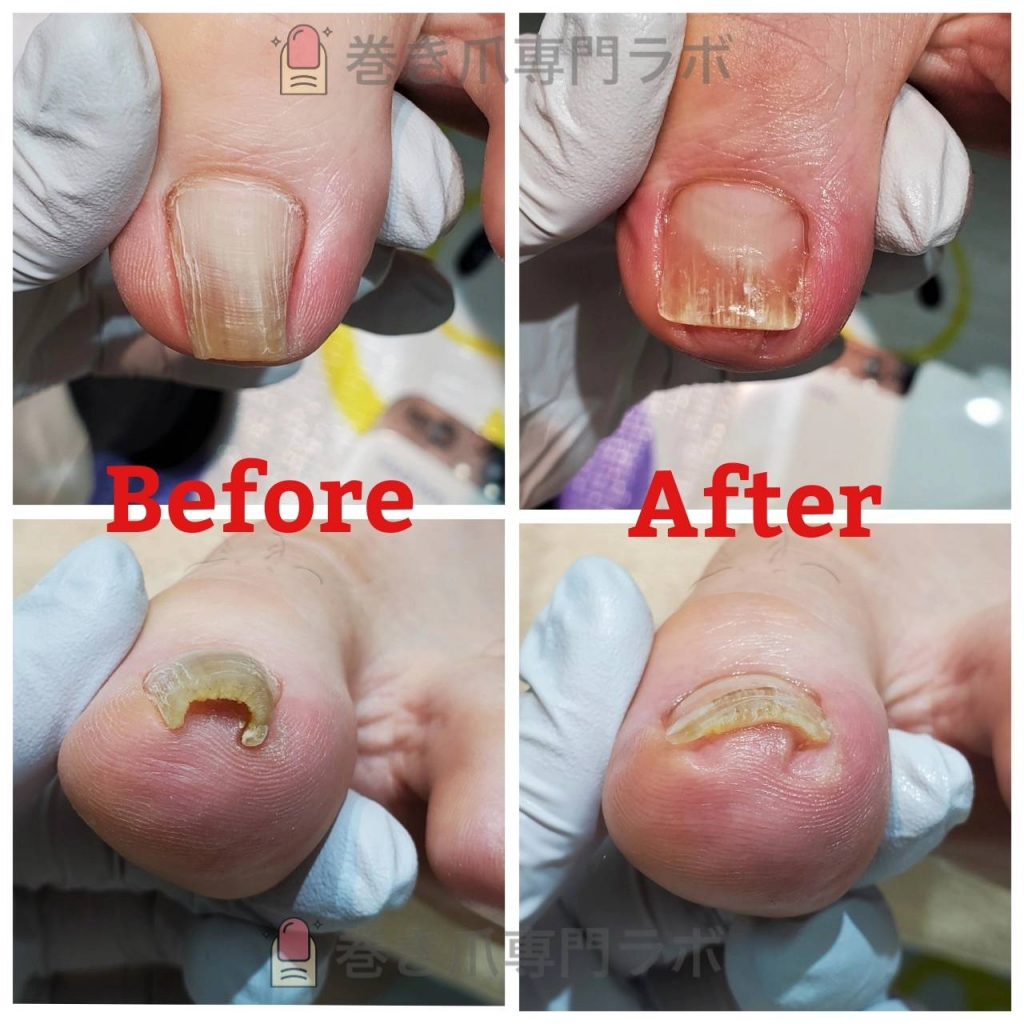 お肉をつまみこんだお爪も