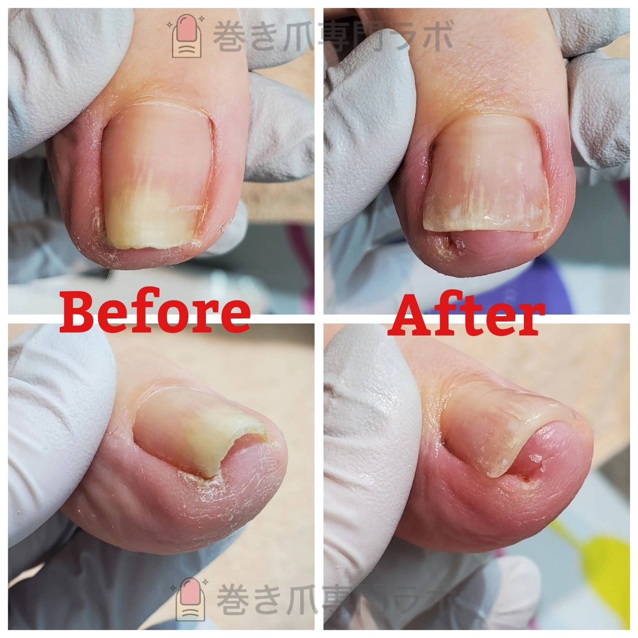 痛みのない隠れ巻き爪を1回で平らに広げた症例のBefore/After｜巻き爪専門ラボ
