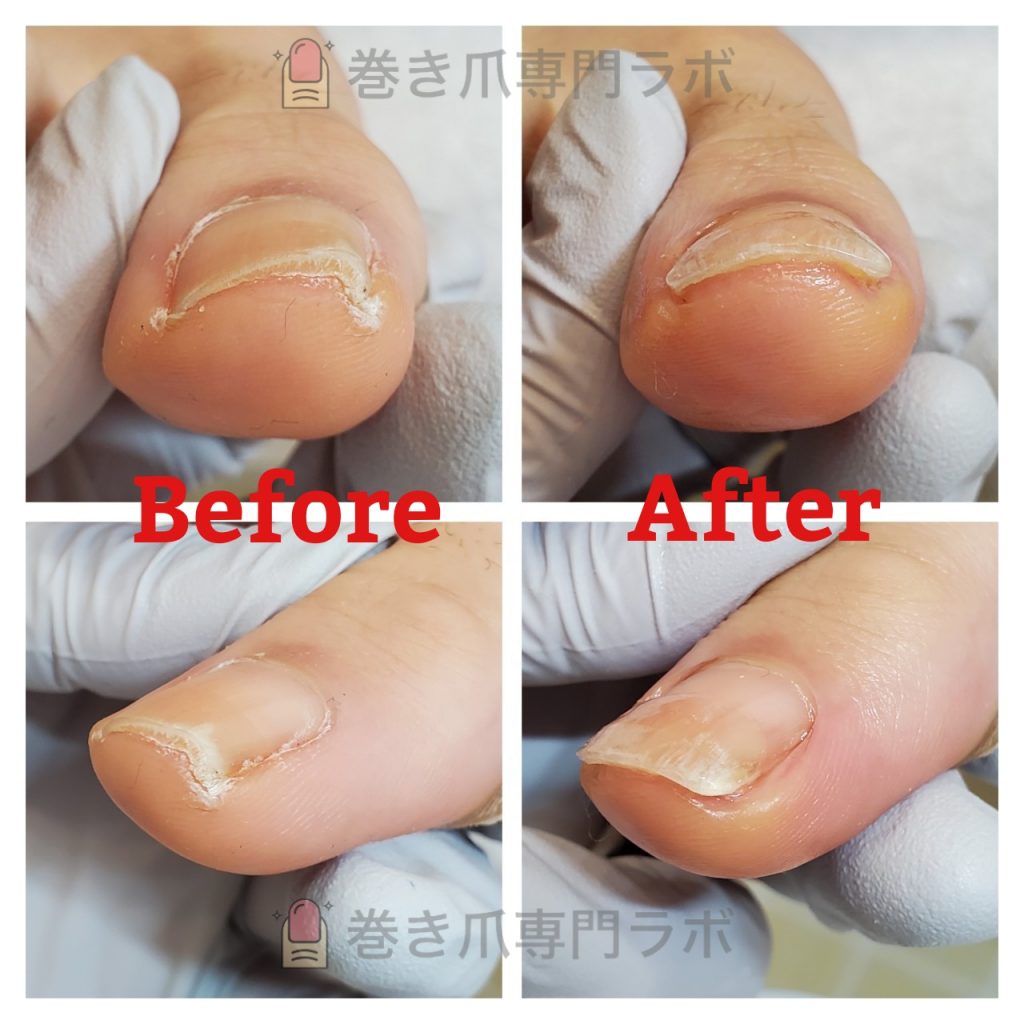 お爪が厚くなって巻いてしまってます