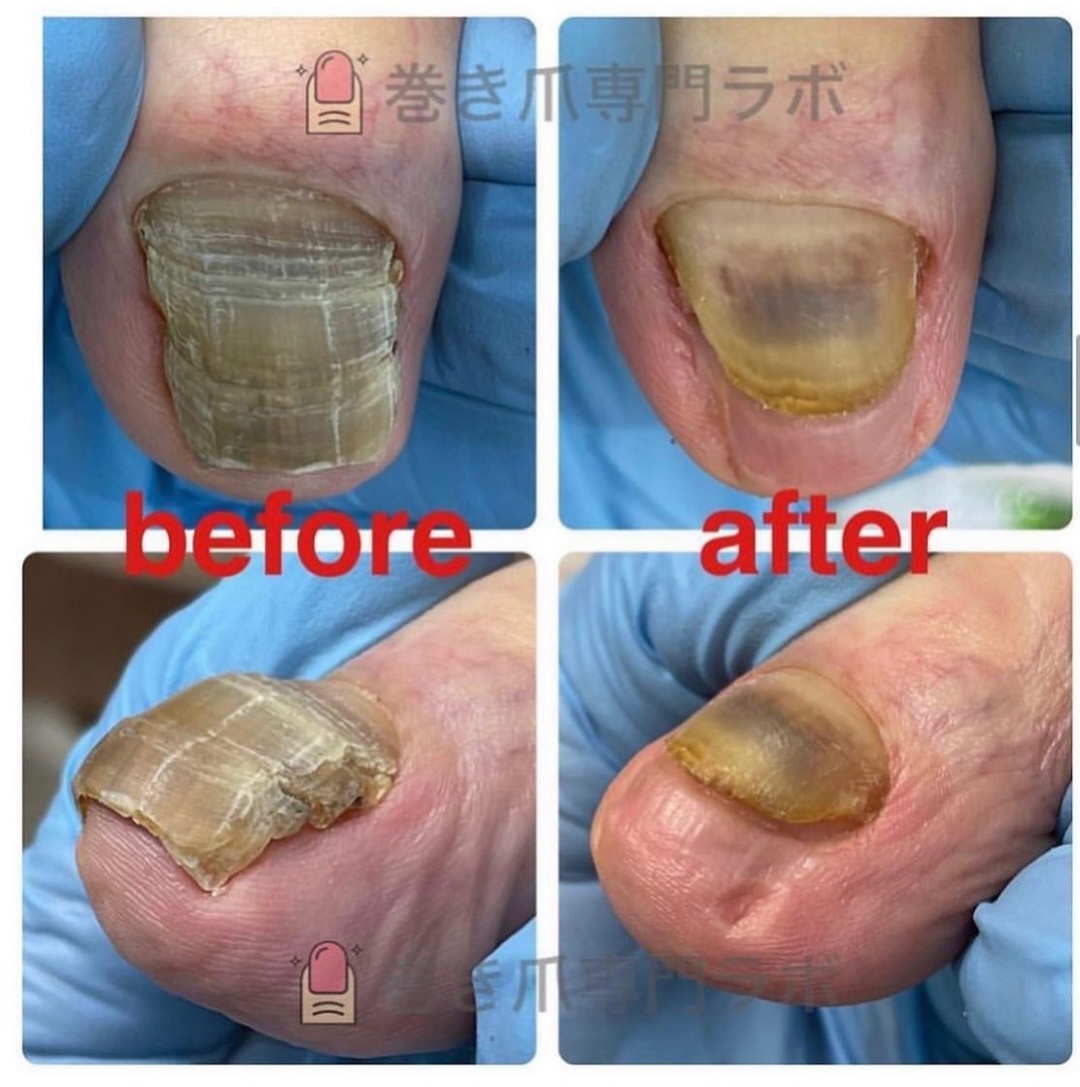 歳のせいと諦めていた分厚い肥厚爪を2回の施術で綺麗に整えた症例のBefore/After｜巻き爪専門ラボ