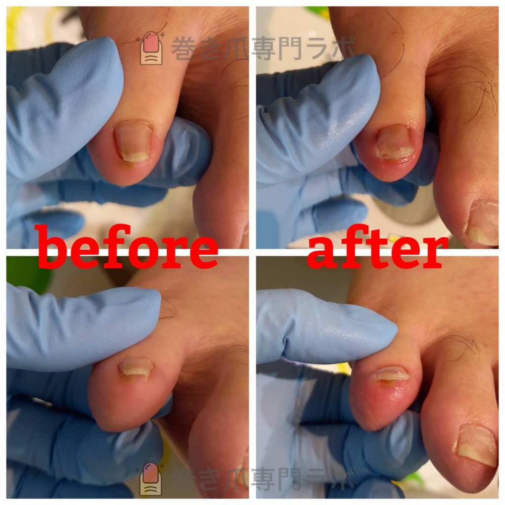 母趾以外の巻き爪