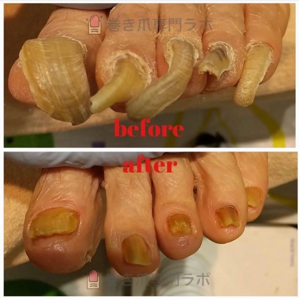 肥厚爪
