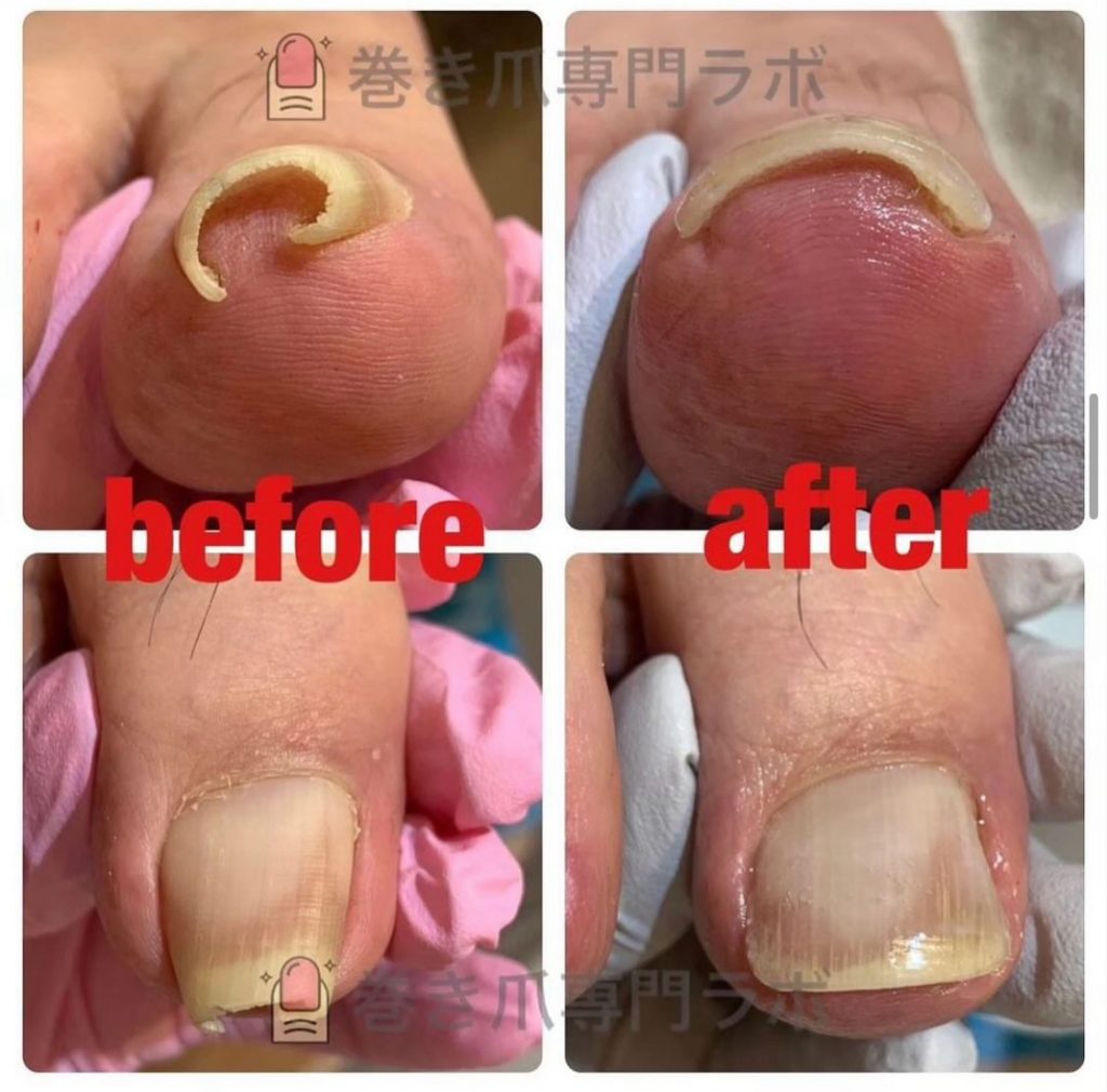 重度の巻き爪も。。✨🫣