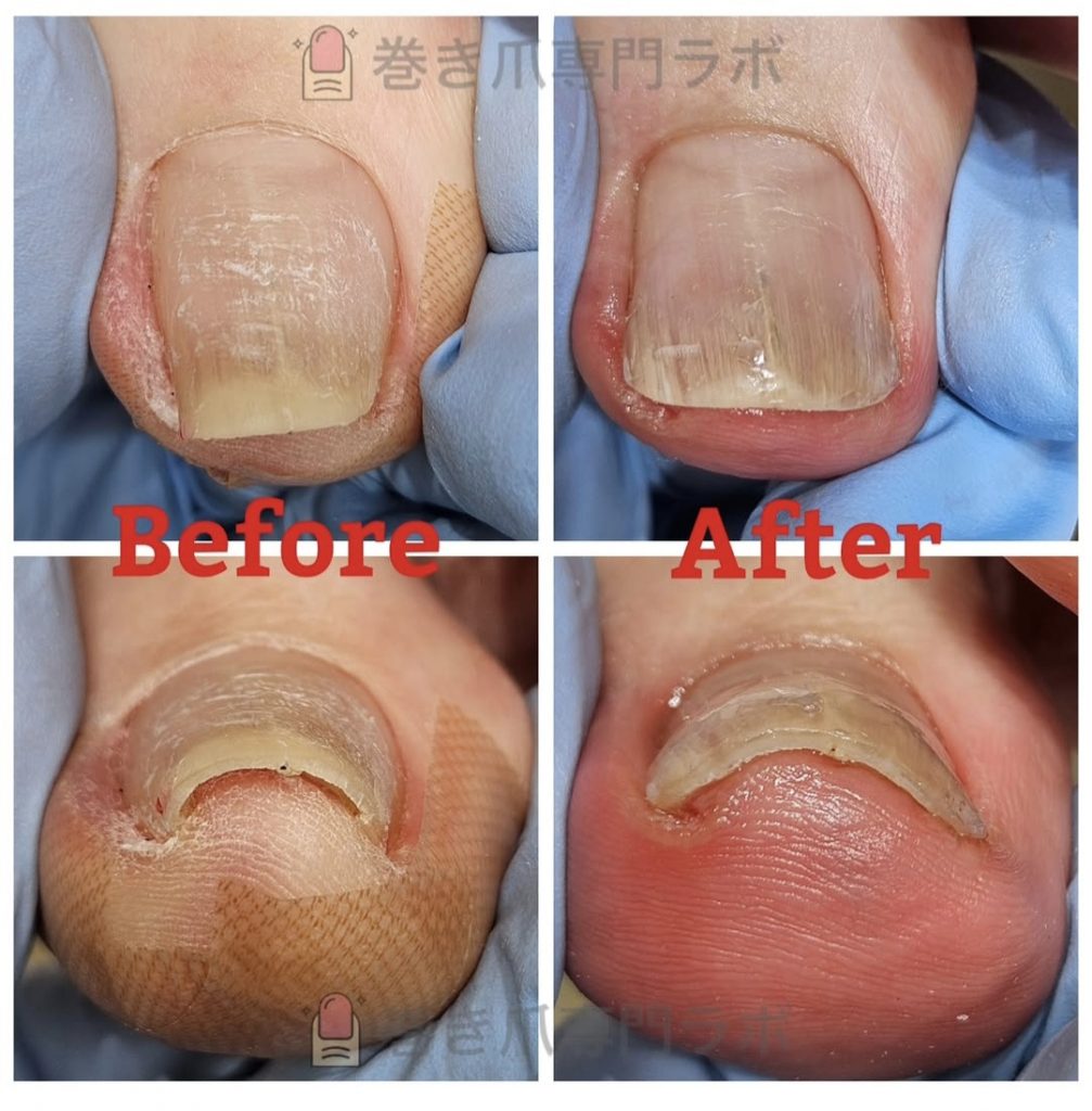 私も巻き爪？