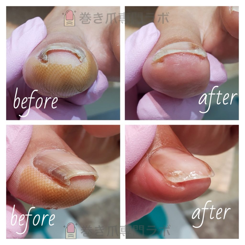 ホッチキスの様に巻いた爪