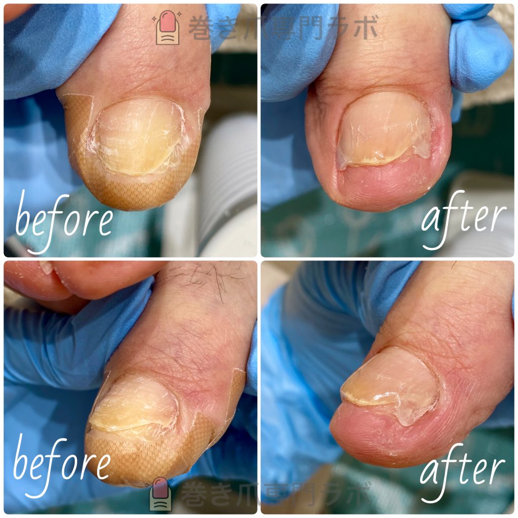 短くなった爪でも