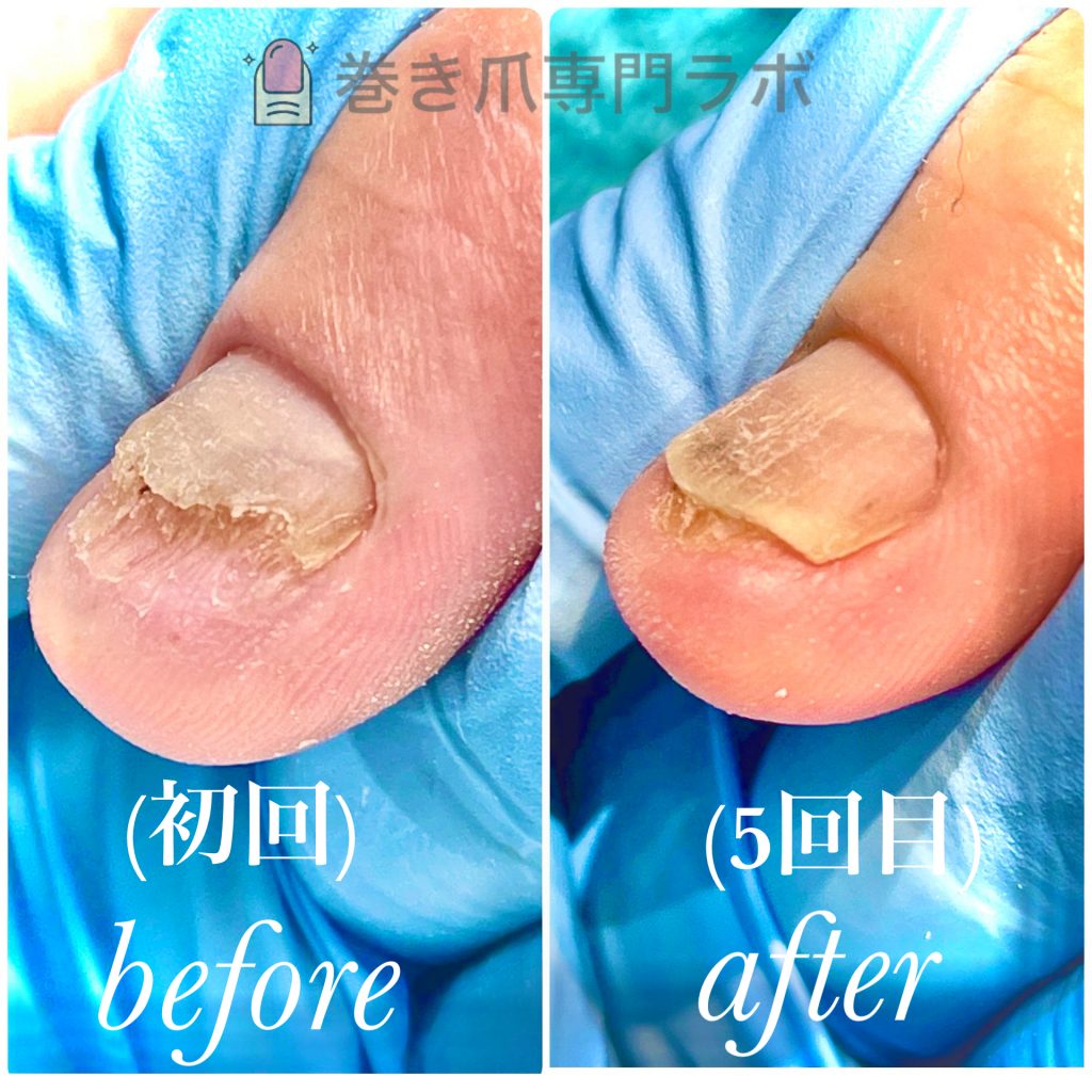爪を噛んでしまう毟ってしまう方必見！