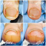 巻き爪の初期症状