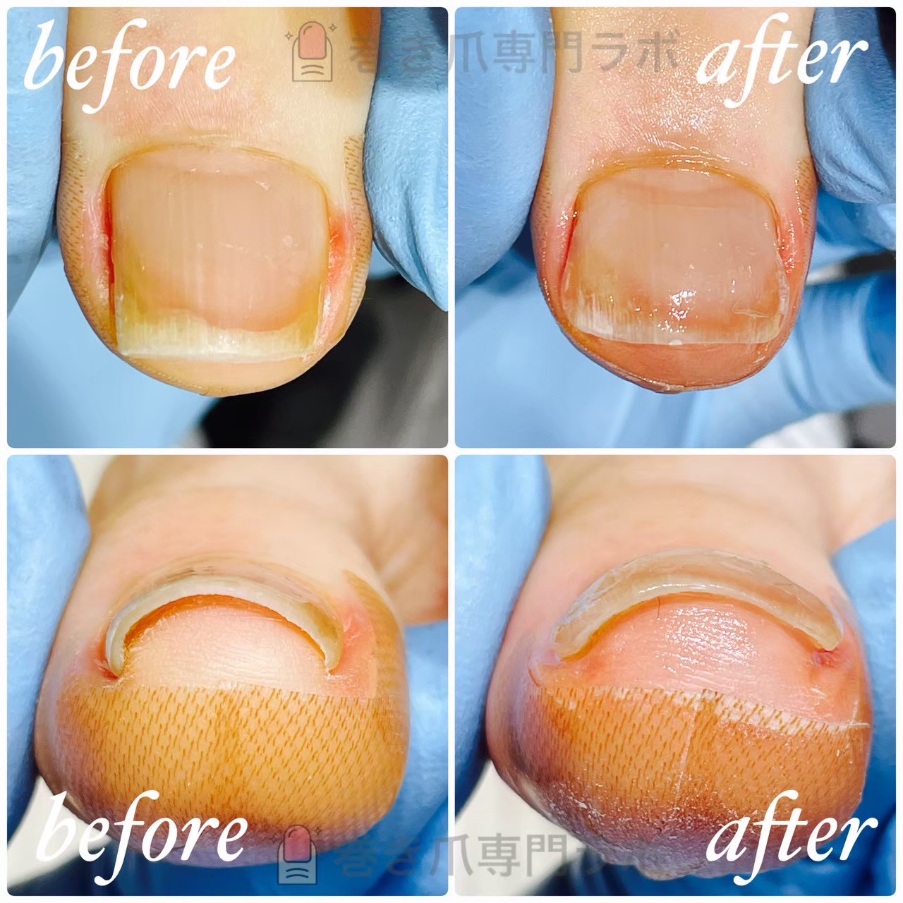 間違ったセルフケアによる深爪から爪の端を1回で引き上げた症例のBefore/After｜巻き爪専門ラボ