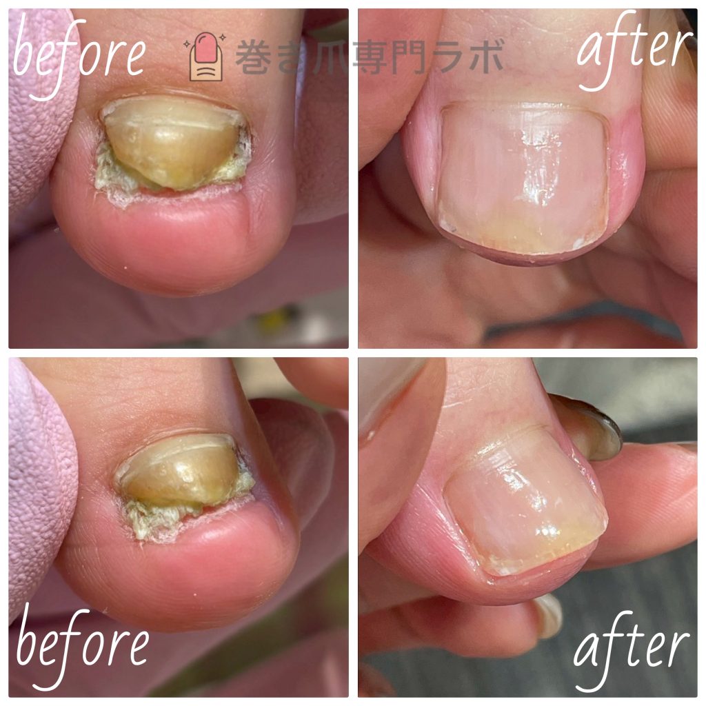 6ヶ月後の肥厚爪の変化