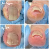 巻き爪の原因の一つ