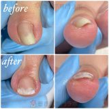 拇趾以外も施術できます