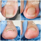 冬に巻き爪が多くなる！？