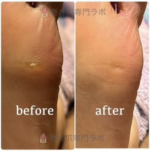 素足の季節が来る前に♪