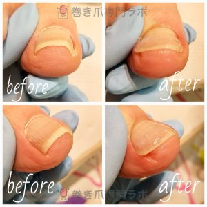 補正後のケアも大事