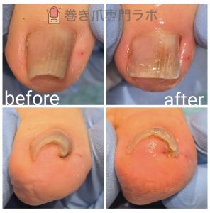 【70代女性・巻き爪症例】靴下を履くだけで痛かった爪の食い込みが1回の施術で解消｜巻き爪専門ラボ