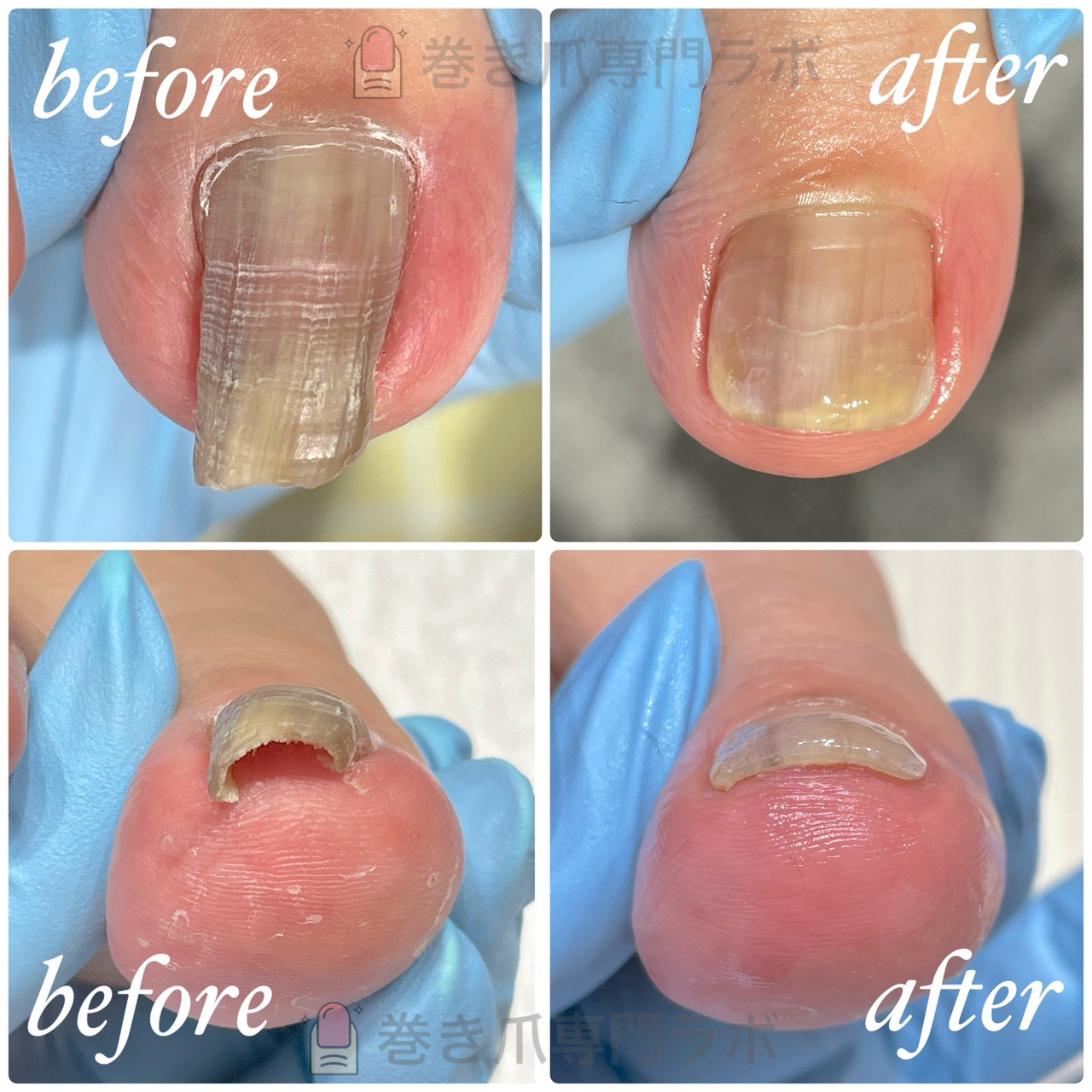 巻き爪施術のBefore/After｜巻き爪専門ラボ
