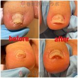 【50代女性・巻き爪症例】3趾（足の中指）の爪が厚く高くなり靴下に引っかかる…1回のケアで引っかかりを解消｜巻き爪専門ラボ